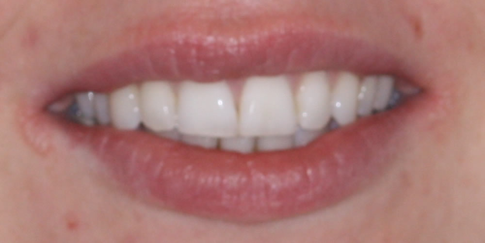 inman aligner in northern ireland