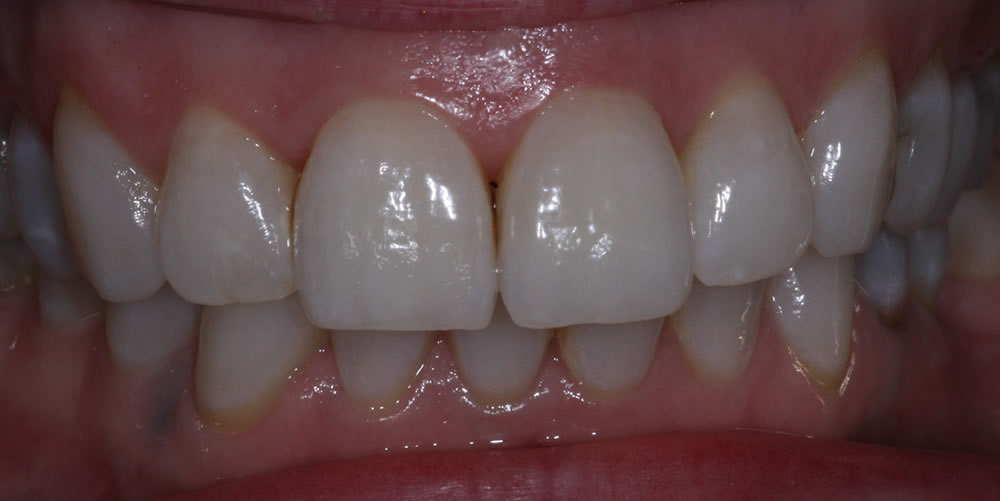 inman aligner in northern ireland