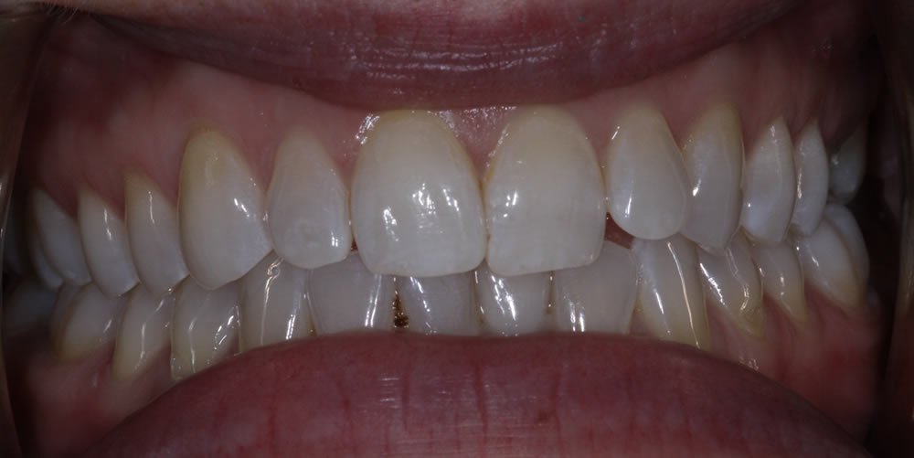 inman aligner in northern ireland