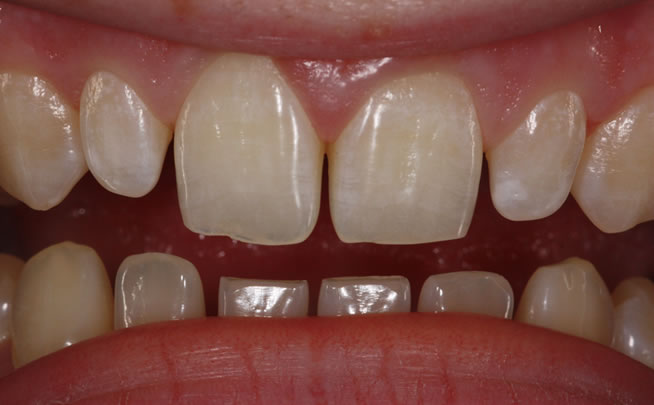 inman aligner in northern ireland