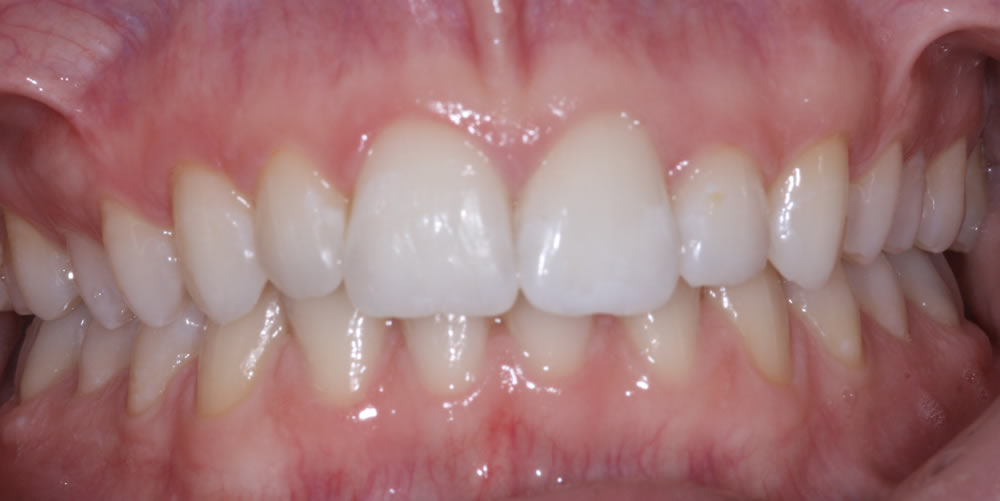 inman aligner in northern ireland