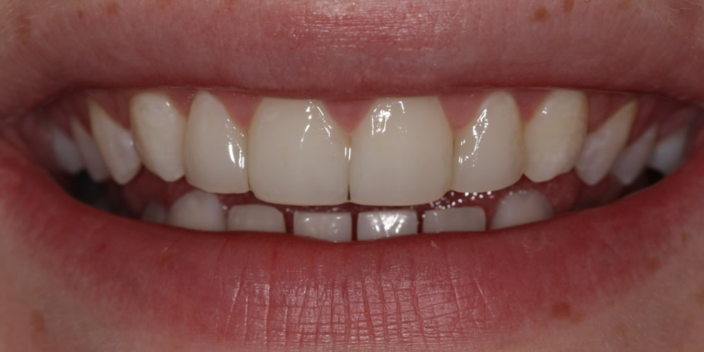 inman aligner in northern ireland